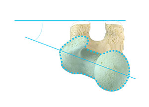Femoroacetabular Osteoplasty