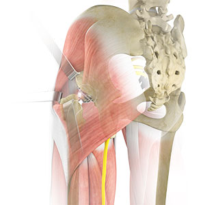 Complex Hip Reconstruction Surgery