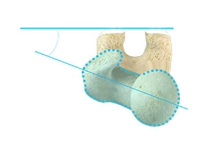 Femoral Derotational Osteotomy