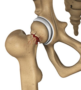 Hip Injury