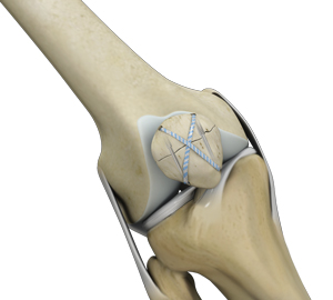 Patient Specific Knee Replacement