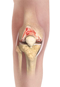 Knee Osteoarthritis