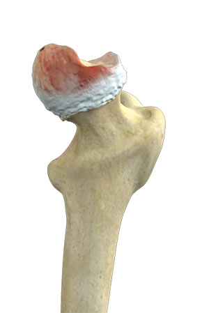 Hip Osteonecrosis