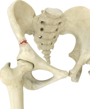 Avulsion Fractures of the Pelvis