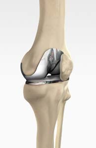 Patellofemoral Knee Replacement